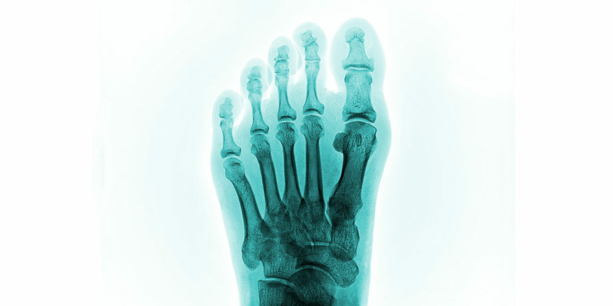 X-Ray film of human feet